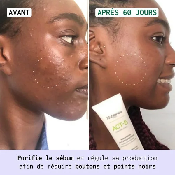 ACT-5 - Soin Intense Anti-Imperfections - Visage - Peaux à Tendance Acnéique, 30ml