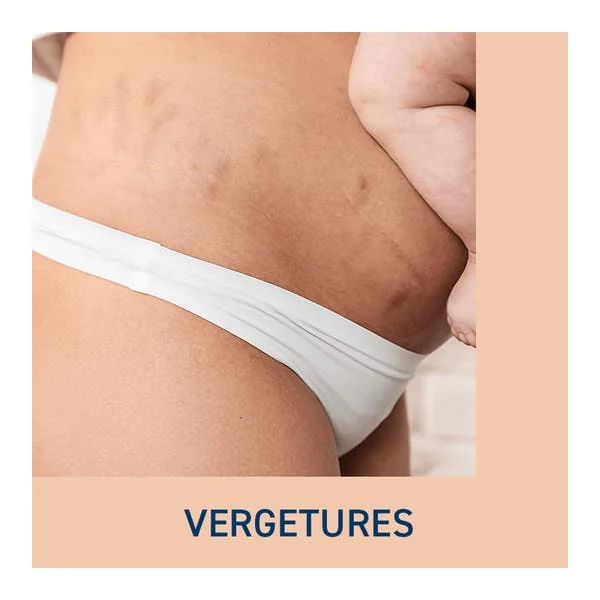Huile de massage vergetures