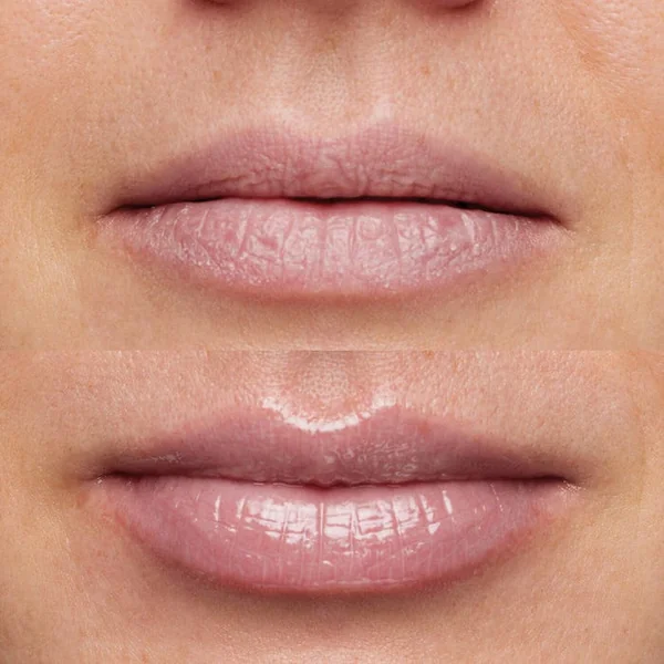 VITAL HYDRA SOLUTION - Masque Hydratant Pour Les Lèvres - Tous Types de Peaux, 20ml